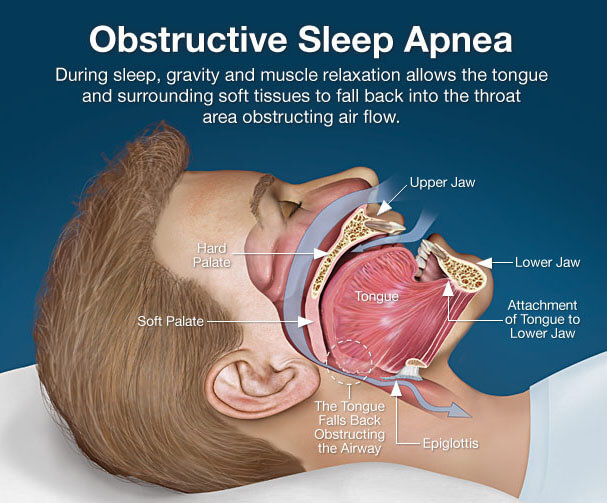 sleep-apnea-snoring-devices-australia