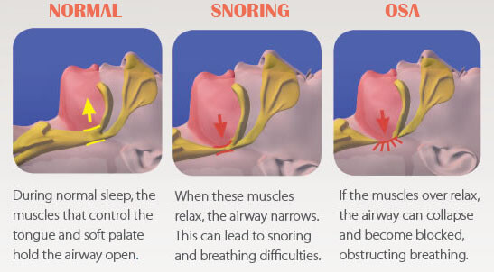 snoring causes