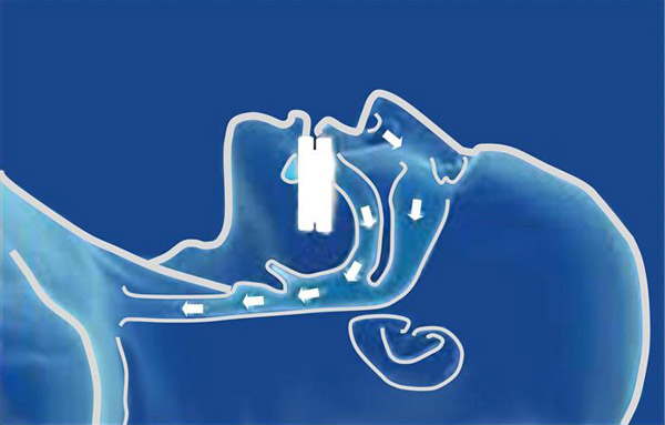 Mouthpieces for snoring